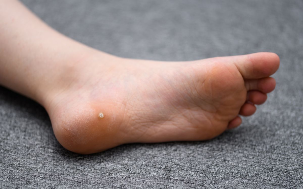 Μυρμηγκιές στα πόδια: Τι τις προκαλεί και πώς φεύγουν mirmigies-sta-podia