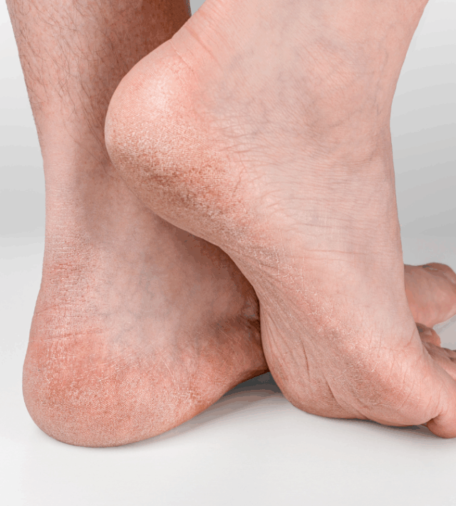 Σκασμένες φτέρνες: Πού οφείλονται και πώς να τις αποφύγετε skasmenes fternes