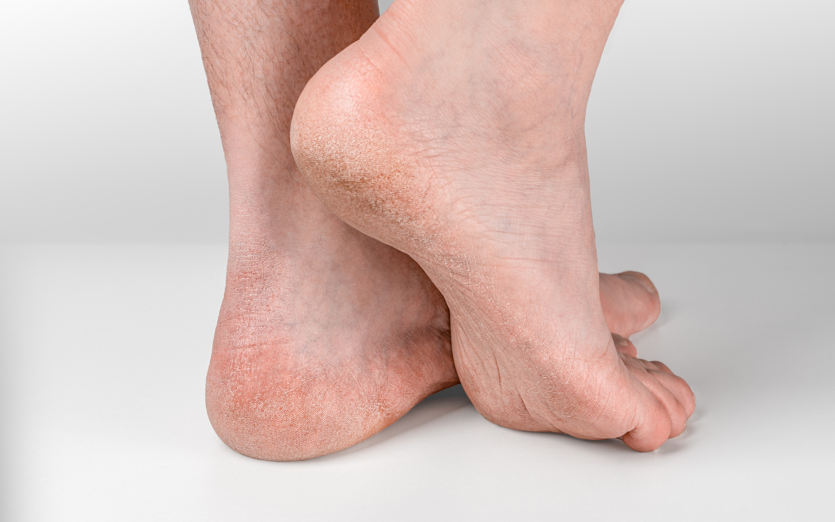 Σκασμένες φτέρνες: Πού οφείλονται και πώς να τις αποφύγετε skasmenes fternes