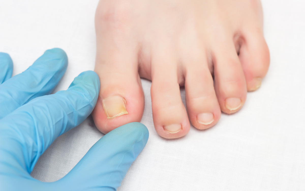 Πώς να αποφύγετε την ονυχοκρύπτωση onixokriptosi tropoi apofigis