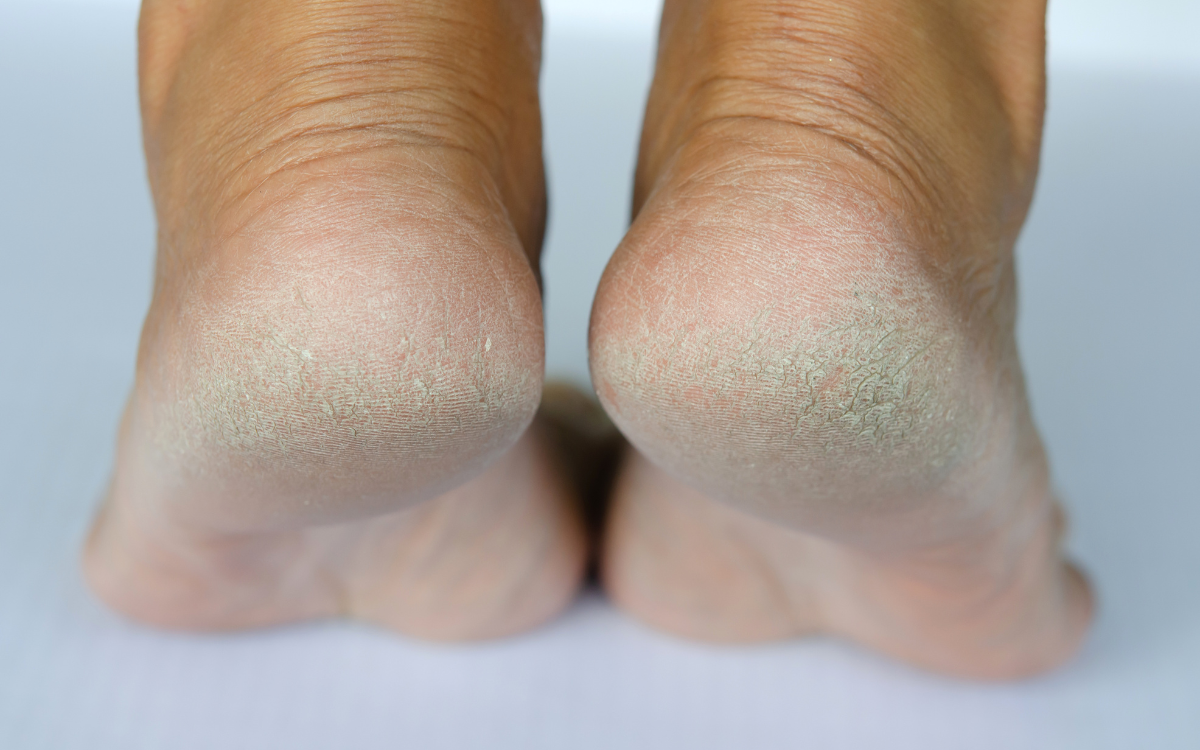 Γιατί σκάνε οι φτέρνες μου; Κυριότερες αιτίες πόδια που έχουν σκασμένες φτέρνες και πατούν σε λευκό φόντο.